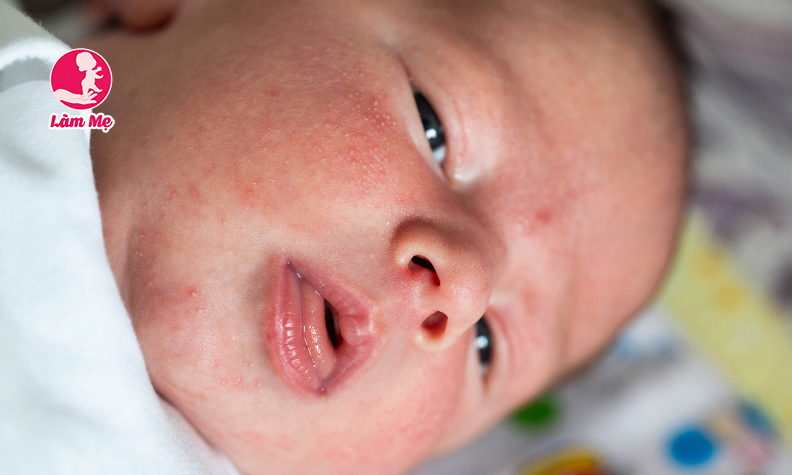 Nguyên nhân gây mụn sữa ở trẻ sơ sinh và cách xử lý
